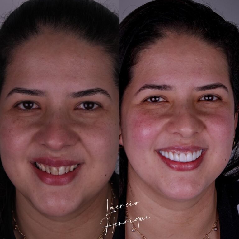 Lentes de resina feitas pelo especialista Doutor Laércio Henrique.