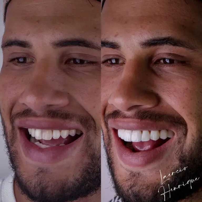Lentes de resina feitas pelo especialista Doutor Laércio Henrique.