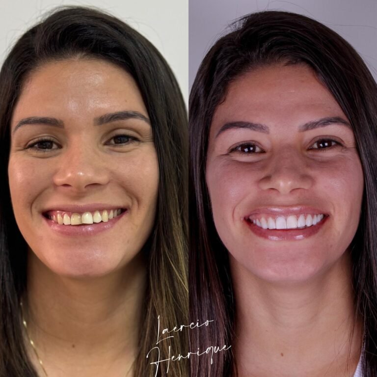 Lentes de resina feitas pelo especialista Doutor Laércio Henrique.