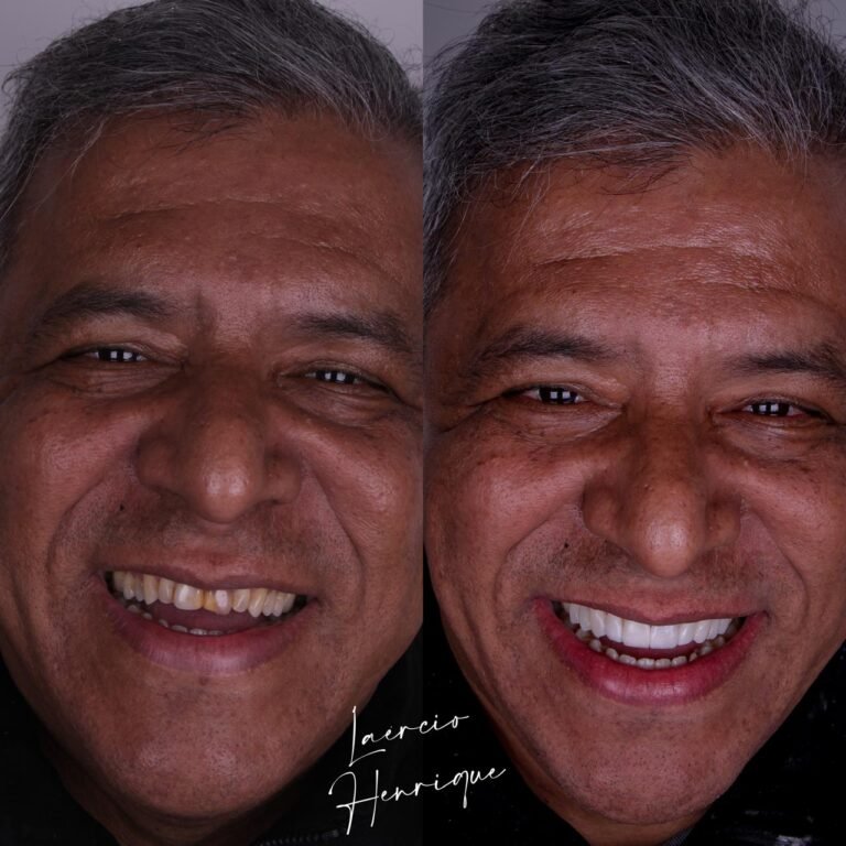 Lentes de resina feitas pelo especialista Doutor Laércio Henrique.