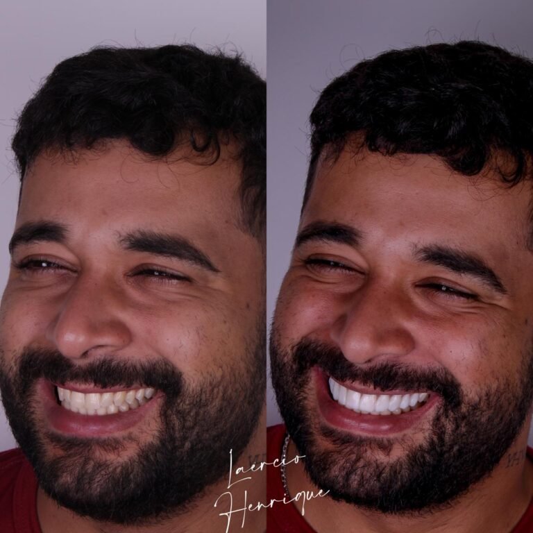 Lentes de resina feitas pelo especialista Doutor Laércio Henrique.