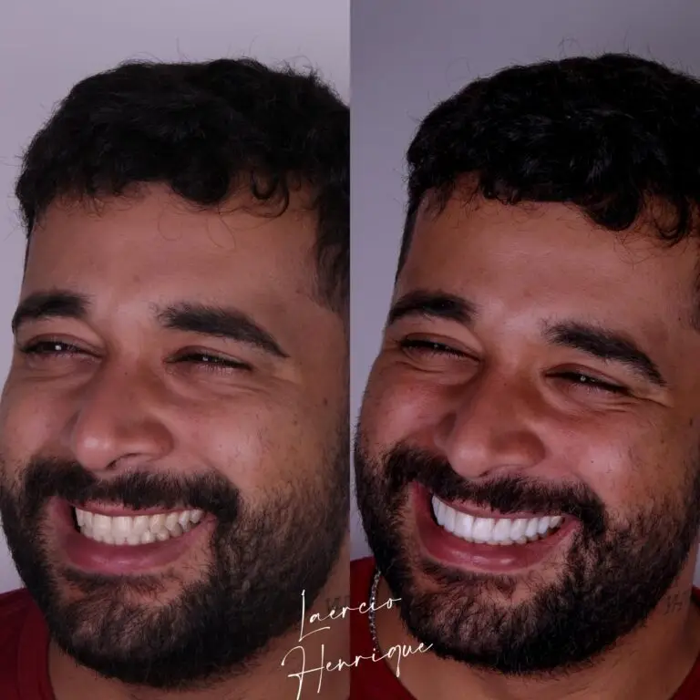 Lentes de resina feitas pelo especialista Doutor Laércio Henrique.