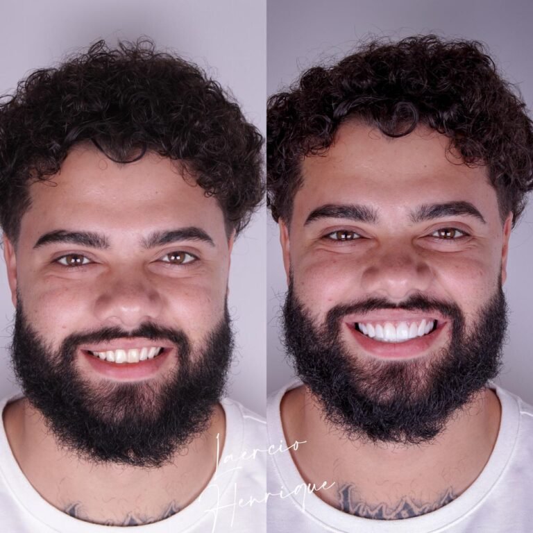 Lentes de resina feitas pelo especialista Doutor Laércio Henrique.