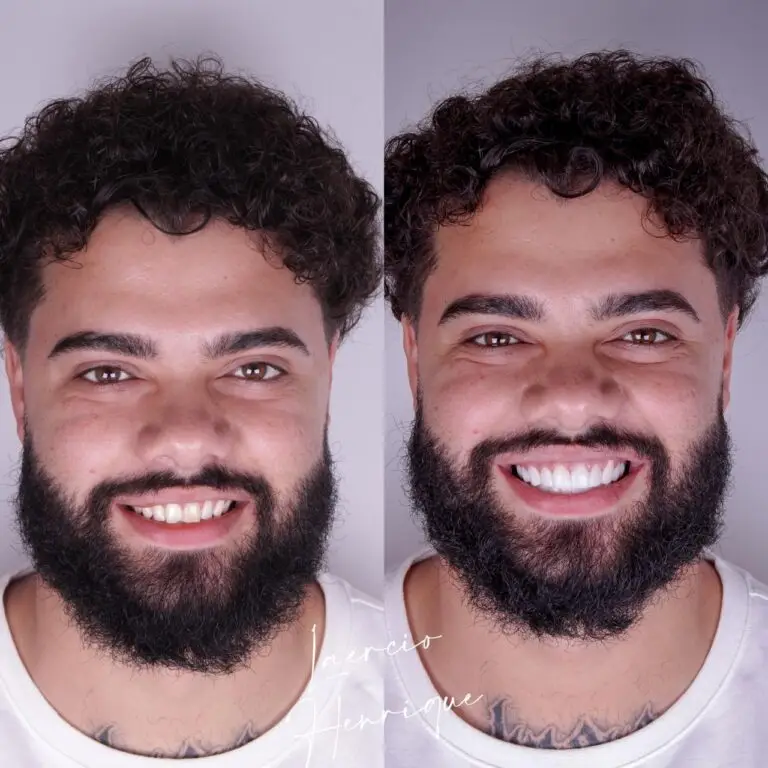 Lentes de resina feitas pelo especialista Doutor Laércio Henrique.