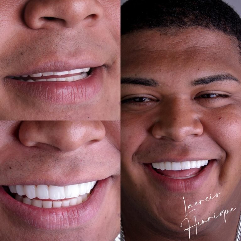 Lentes de resina feitas pelo especialista Doutor Laércio Henrique.