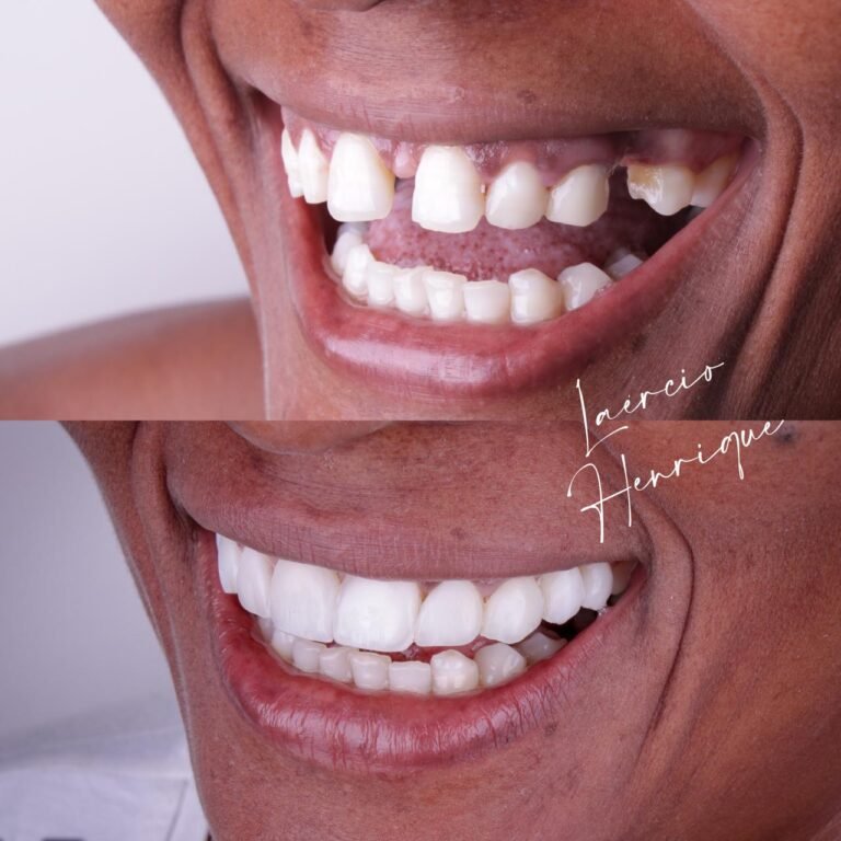 portfolio-dr-laercio-henrique-lentes-de-resina-especialista (8)