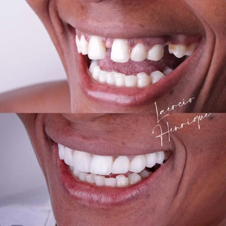 portfolio-dr-laercio-henrique-lentes-de-resina-especialista (8)